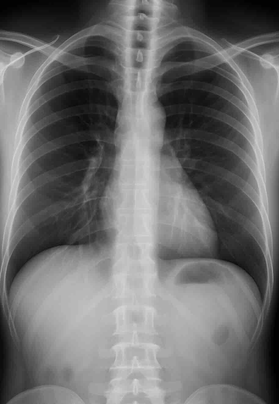 Chest X-Ray